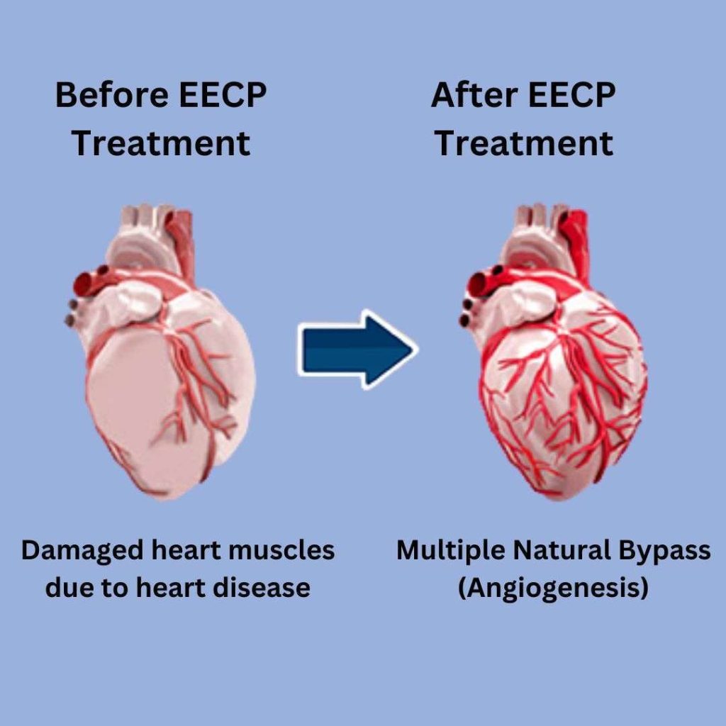 EECP Treatment Session