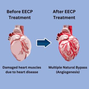 EECP Treatment Session