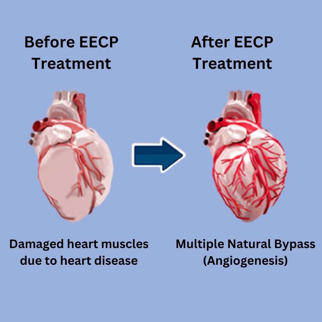 EECP Treatment Session